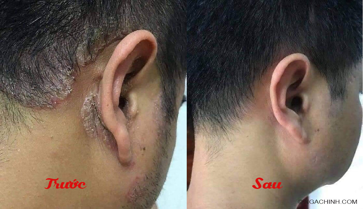 Nấm da đầu người lớn trước và sau khi điều trị bằng thuần mộc